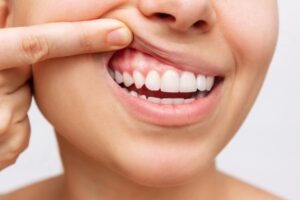 Tratamento de periodontia em Salvador para saúde da gengiva e prevenção da doença periodontal