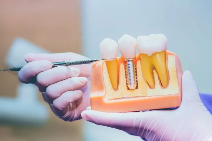 Implante dentário em Salvador com planejamento digital no Salvador Dental Studio